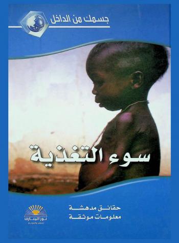  سوء التغذية